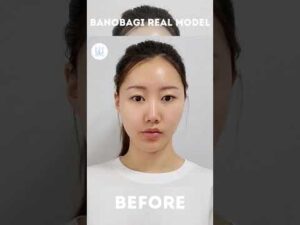 BANOBAGI MEDICAL GROUP – Before & After💓 Full Face Contouring+Undereye Fat Repositioning 💓